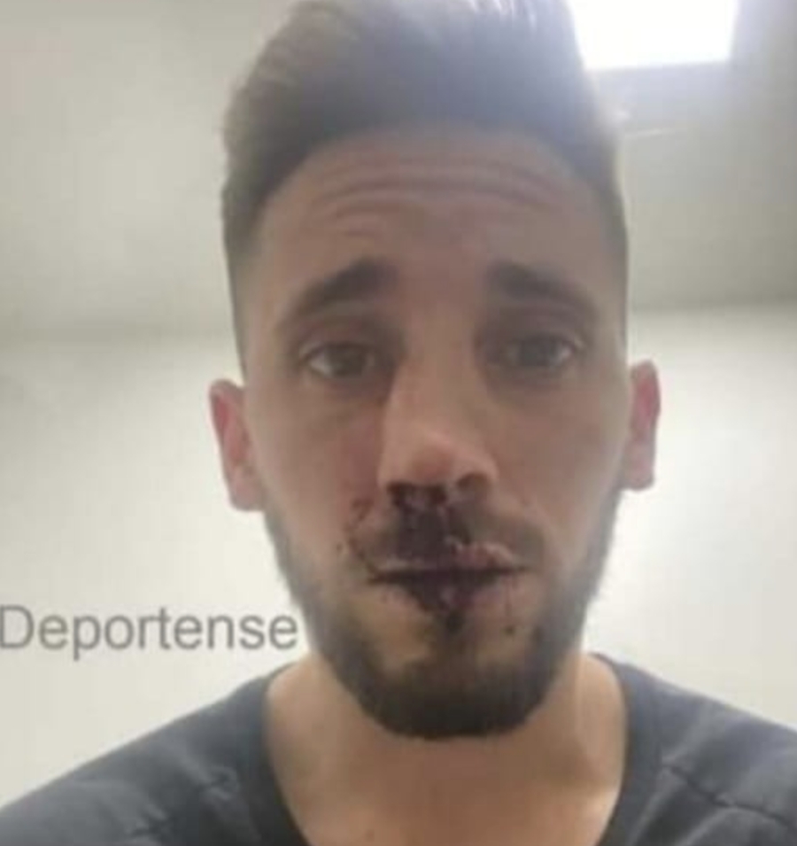 Nicolás Morgantini, futbolista de Platense, fue herido y sufrió la fractura de su tabique.