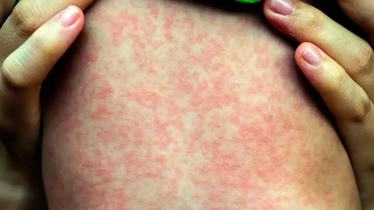 El Ministerio de Salud emitió una alerta por cuatro casos confirmados de…