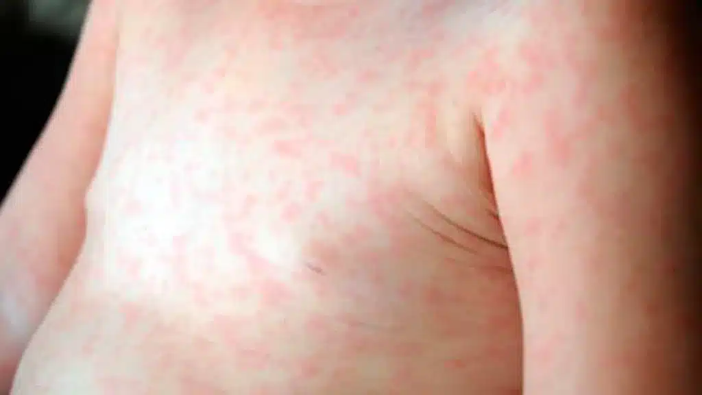 Alerta epidemiológica por sarampión en la provincia de Buenos Aires: cuatro…