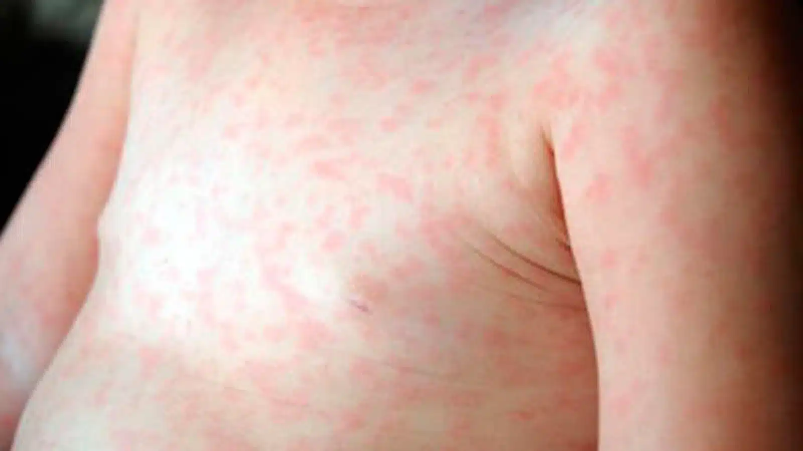 Alerta epidemiológica por sarampión en la provincia de Buenos Aires: cuatro…